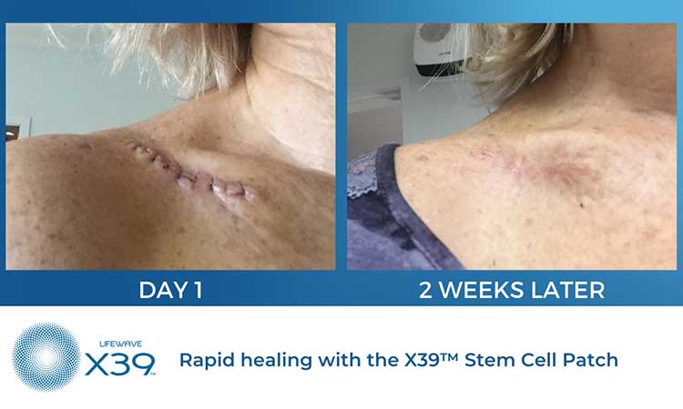 Stem Cell Patches Review